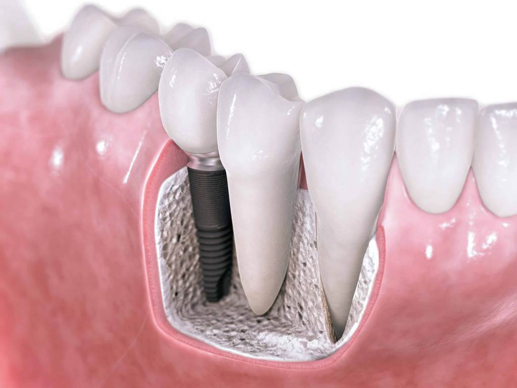 Implantologija u Sisku – Dosezi suvremene dentalne medicine Implantologija u Sisku – Dosezi suvremene dentalne medicine